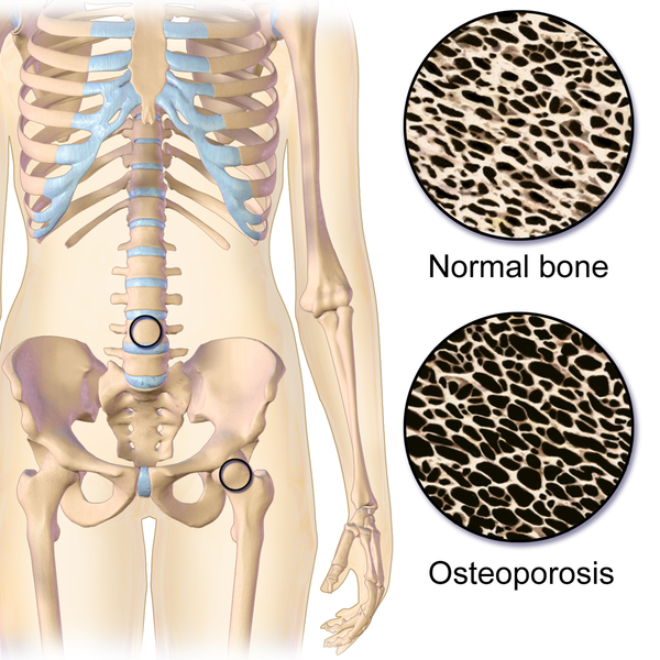 Difference Between Arthritis And Osteoporosis Compare The Difference Between Similar Terms