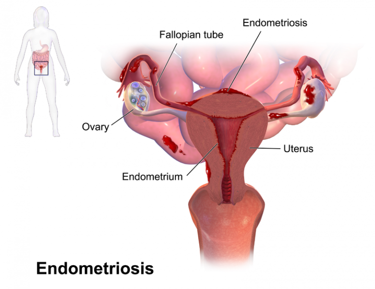Difference Between Pcos And Endometriosis Pcos Vs Endometriosis