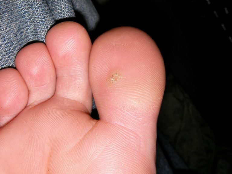 Difference Between Callus And Wart 1 768x576 